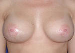 after breast augmentation