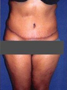after liposuction