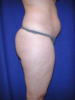 after liposuction