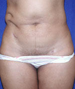 before liposuction