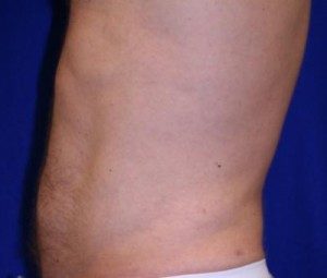 after male liposuction 