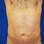 after male liposuction 