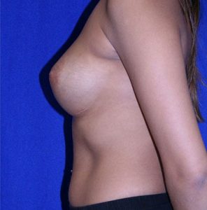 after breast augmentation 