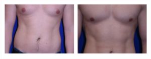before and after gynecomastia
