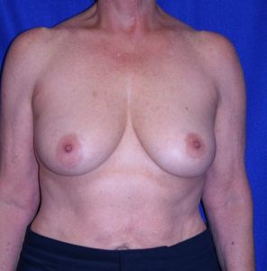 woman after breast augmentation