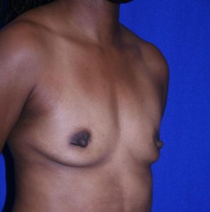 woman before breast augmentation