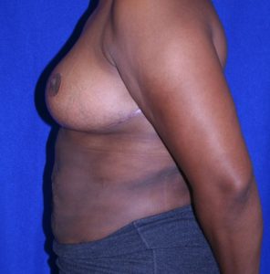 woman after breast reduction