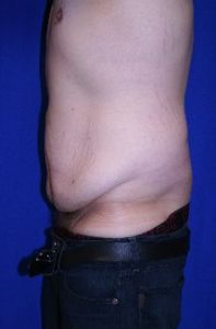 male before abdominoplasty