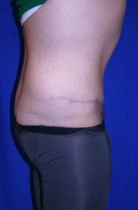 male after abdominoplasty