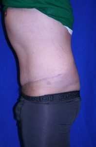 male after abdominoplasty