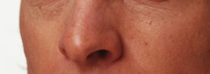 nose of a man after a rhinoplasty