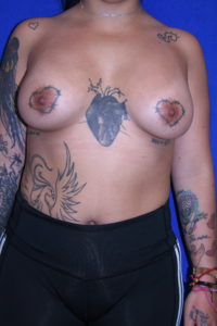 Patient after breast augmentation