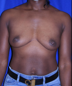 Patient before breast augmentation