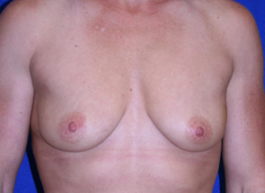 before breast surgery