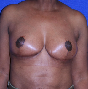 after breast surgery