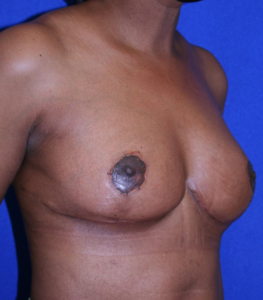 after breast surgery