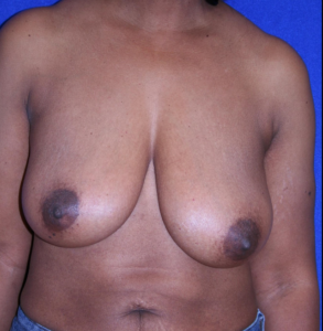 before breast surgery