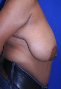 breast before surgery