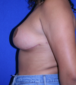 after Breast Reduction
